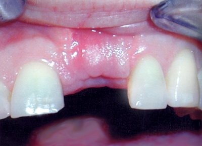 Надо ли ставить зубной протез после удаления зуба?