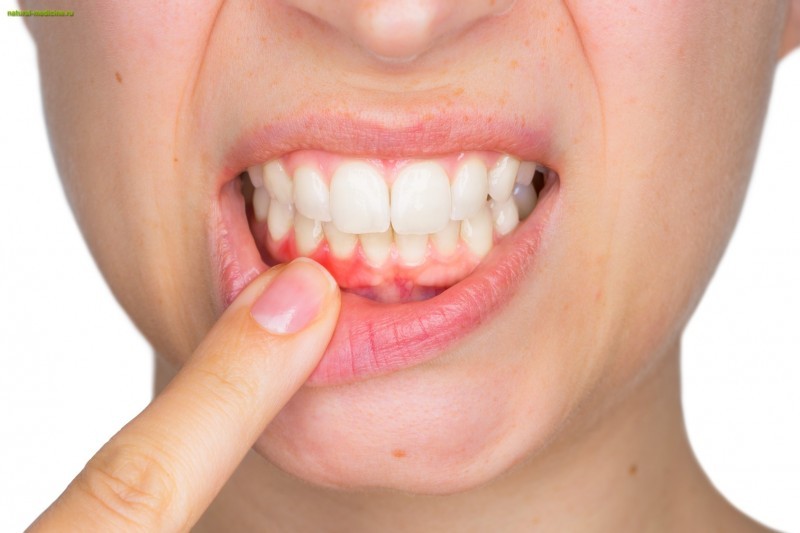 Очищаем зубы от камня в домашних условиях: 6 средств