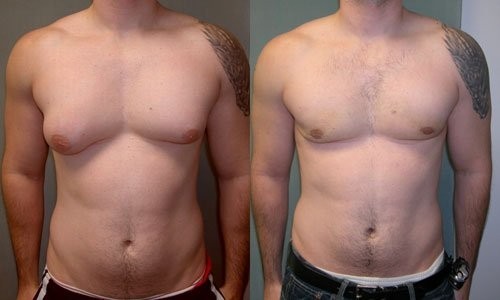 Уменьшение груди — самая популярная операция у мужчин