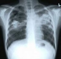 Лечение туберкулеза легких и пролежней