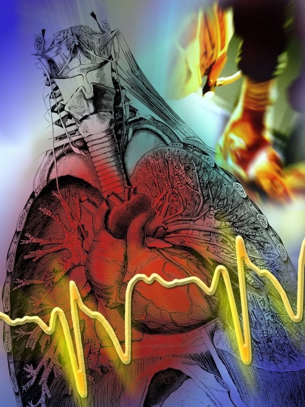 Инфаркт миокарда: факторы риска, симптомы, профилактика
