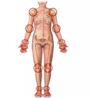 Артрит и артроз суставов: причины и профилактика. Рассказывает врач-ревматолог
