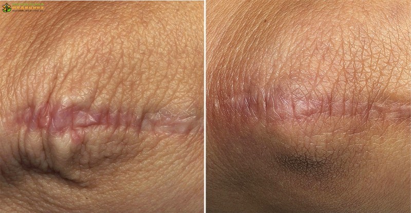 Как избавится от страшных шрамов на лице за 12 месяцев?