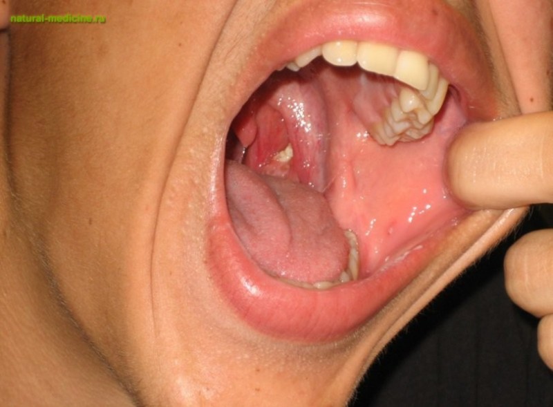 Как удалить тонзиллолиты или пробки из миндалин в горле: 4 способа
