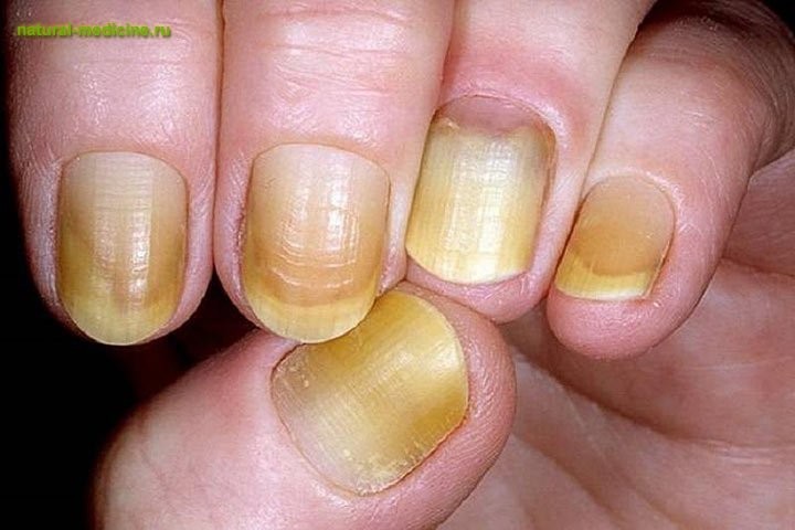 Причины пожелтения ногтей