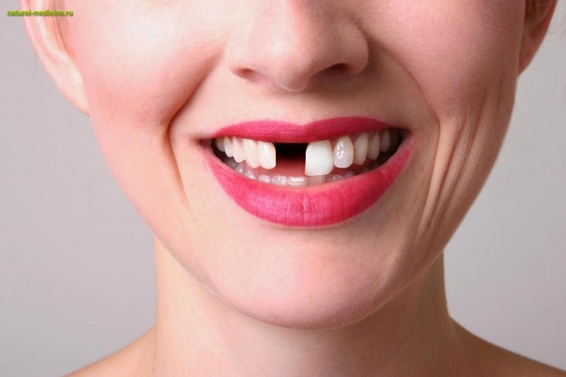 Почему выпадают зубы: 3 основные причины