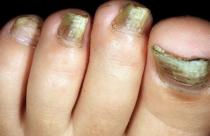 Изменения цвета ногтей, расслоение - основные причины и признаки ногтевого грибка
