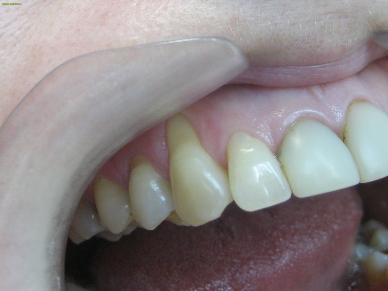 Эрозия эмали зубов: причины, возможные последствия, диагностика и лечение