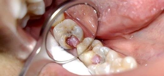 Удаление нерва (пульпы) из зуба. Как это происходит?