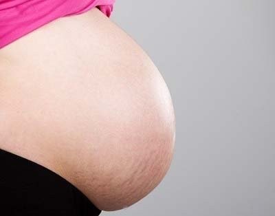 Растяжки во время беременности. Как правильно с ними бороться?