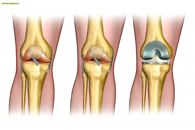 Эндопротезирование коленного сустава: показания и противопоказания, квоты, виды эндопротезирования, ЛФК