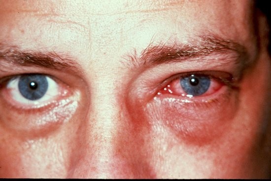 Народные средства от воспаления глаз и других проблем