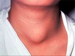 Определяем болезнь щитовидной железы по симптомам