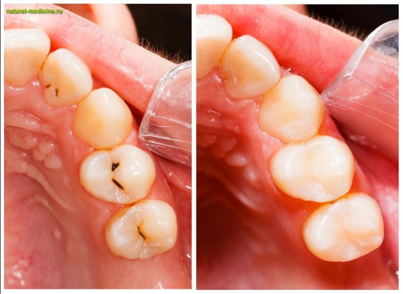 Биокомпозиционные пломбы – будущее стоматологии