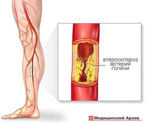 Как улучшить кровообращение ноги