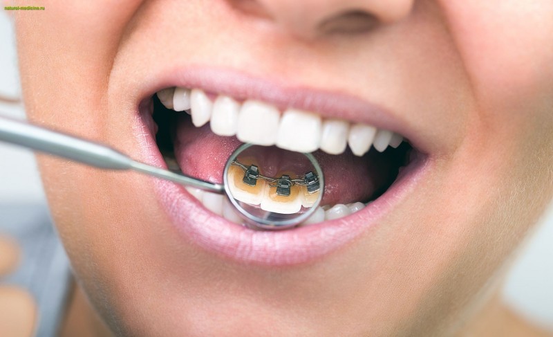 Лингвальные брекеты - эффективное и незаметное выравнивание зубного ряда