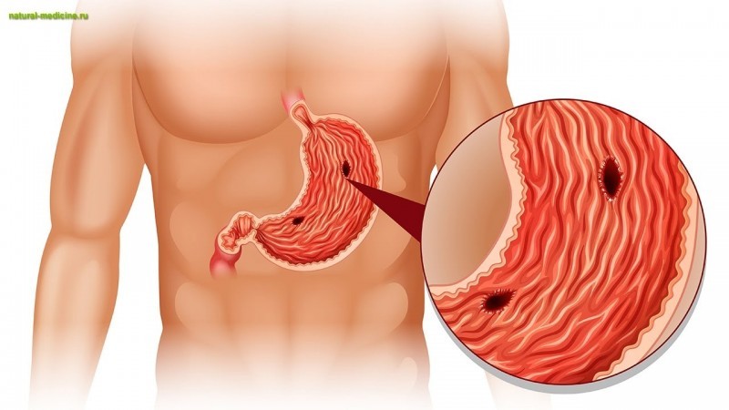 Заболевания желудочно-кишечного тракта