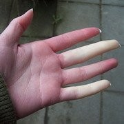 Как избавиться от онемения рук