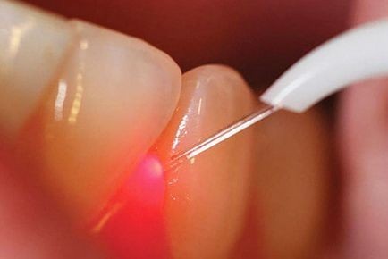Лазерная имплантация зубов: безболезненно и эффективно