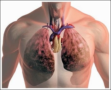 Рак лёгких: ранние симптомы, факторы риска, диагностика, лечение