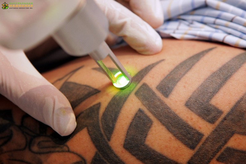 Лазерное удаление татуировки: процедуры и 5 побочных эффектов