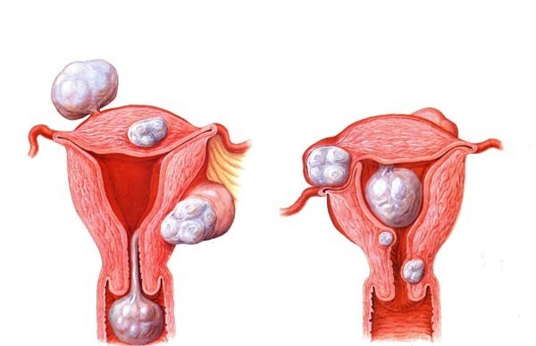Лечение миомы, фибромы и фибромиомы матки народными средствами