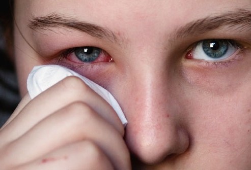 Как вылечить воспаленные глаза?