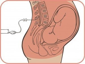 Использование эпидуральной анестезии во время родов