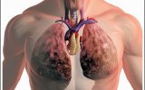 Рак лёгких: ранние симптомы, факторы риска, диагностика, лечение