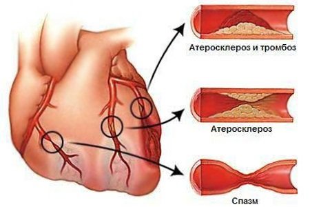 Ишемическая болезнь сердца: народное лечение и советы врачей-специалистов