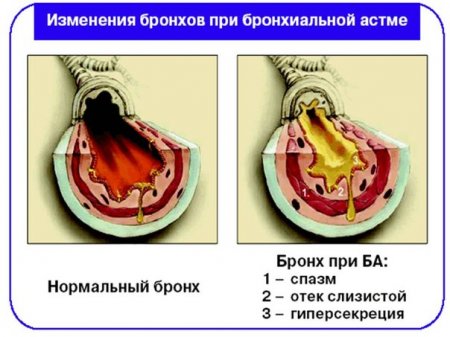 Первая мед помощь при бронхиальной астме
