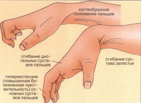 анкилоз пальцев