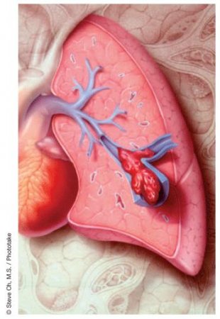 Тромбоэмболия легочной артерии (закупорка тромбами)