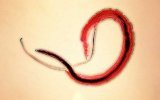 Шистосомозы (плоские черви)