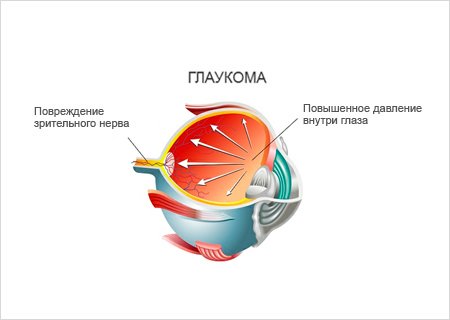 Глаукома и использование глазных капель