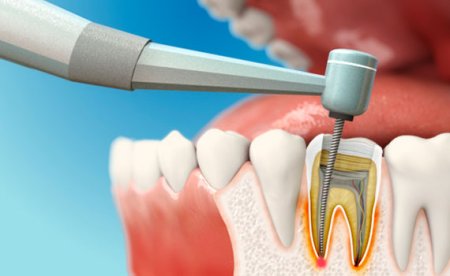 Повторная очистка внутренней части зуба.